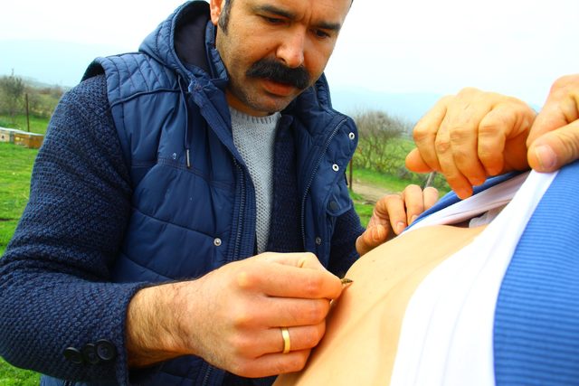 Böyle tedavi yöntemi görülmedi! �Alerji testi yaptırmayan denemesin