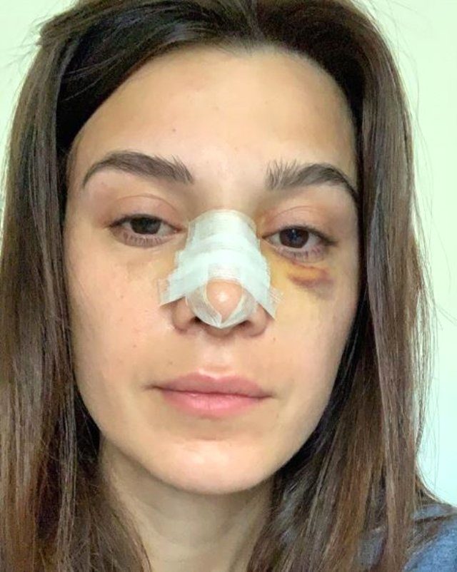 Cnn Turk Spikeri Busra Sanay Kaza Sonrasi Goruntusuyle Korkuttu