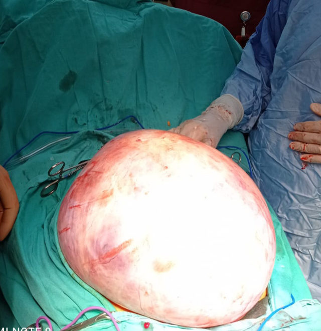 karnindan-5.5-kilo-agirliginda-tumor-cikti_9970_dhaphoto2