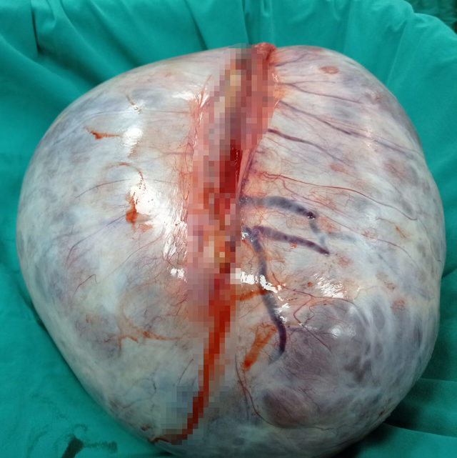 karnindan-5.5-kilo-agirliginda-tumor-cikti_9970_dhaphoto4 (1)