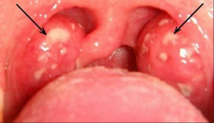 İltihaplı bademcikleri antibiyotik kullanmadan iyileştirmenin en basit yolu! İltihaplı bademcikleri antibiyotik kullanmadan iyileştirmenin en basit yolu!