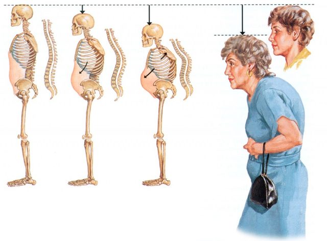 Osteoporoz